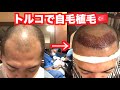 【自毛植毛日記第１弾】カウンセリンング〜手術【前編】