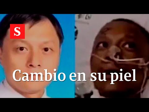 Murió médico que presentó notable cambio de color de piel por coronavirus | Video semana