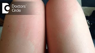 Causes of Itchy Bruise on Thigh and how to manage it - Dr. Amee Daxini