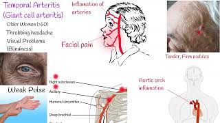Temporal Arteritis (Giant Cell arteritis); Symptoms and treatment