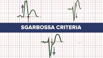 Sgarbossa Criteria - MEDZCOOL