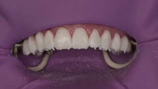 Clinical Tip on veneer temporization