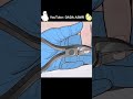ASMR｜Ingrown Toenail and Corn removal treatment animation | 凍甲(甲溝炎＆雞眼治療動畫｜내성발톱&티눈 치료｜魚の目の芯を取る 巻き爪治療2