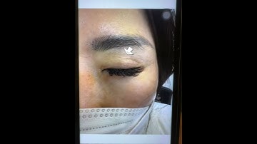 Xoá sẹo cắt mí - Treatment Scar #Nanozelle #Coldplasma #plasmaclass #plasmaacademy