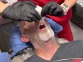 CRNA Anesthesia Nasal Intubation POV Dental Office