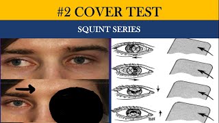 COVER TESTS | Direct Cover , Indirect cover , Cover-Uncover and Alternate cover test