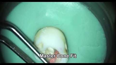 Vertical condensation technique step by step