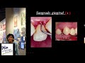 Nuevo sistema de clasificación para la periodontitis