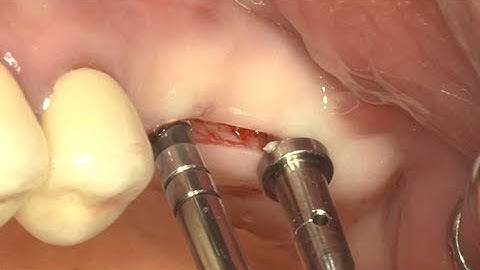 Simple sinus lifting using Osteotome and Implant Guide Kit