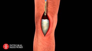 Medical Animation - Tibia Fracture