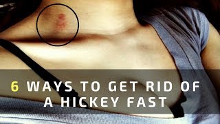 6 Ways to Get Rid of a Hickey Fast and Easy Overnight