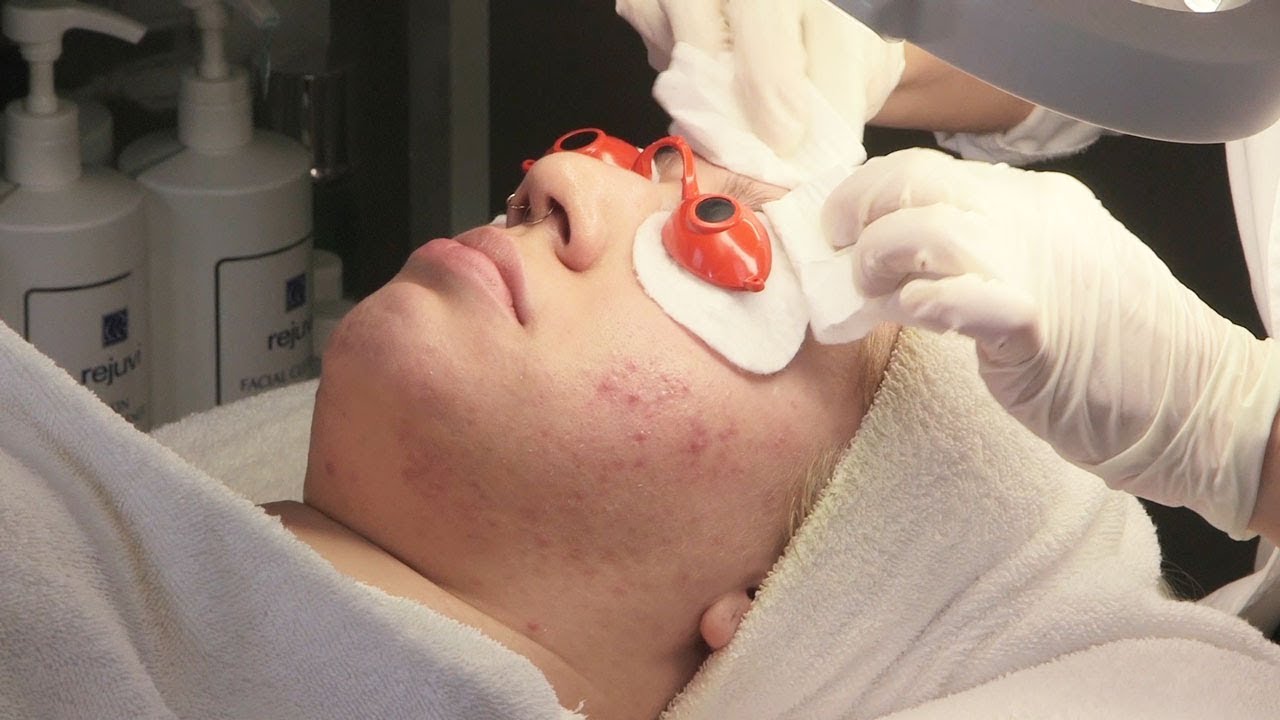 Pimples - Facial for pimples - New porn