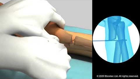 Distal radius fracture fixation with bioabsorbable ActivaPin by Dr. Varga and Dr. Kassai