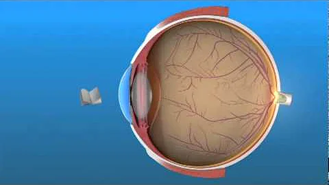Presbyopia - DayDayNews