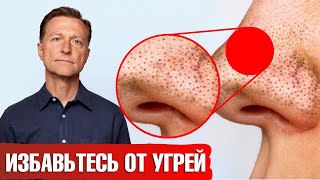 Достали комедоны? Исключи эти продукты и угри пройдут навсегда🙌