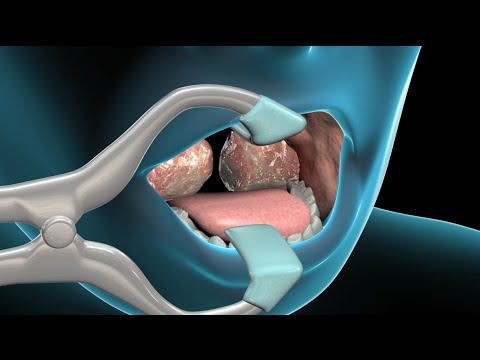 Video: Removal Of Tonsils In Chronic Tonsillitis: Reviews And Consequences