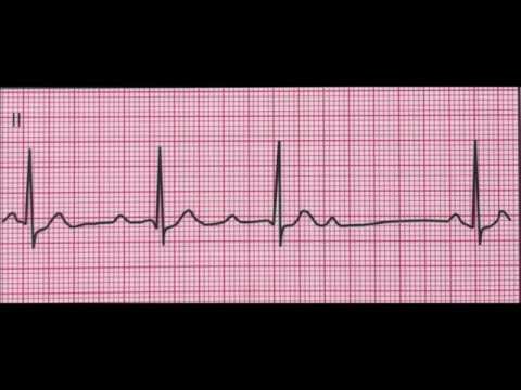 Vidéo: Bloc Cardiaque (Mobitz Type I) Chez Les Chiens