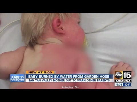 Arizona Boy Gets Second-Degree Burns When His Mom Fills Up His Pool