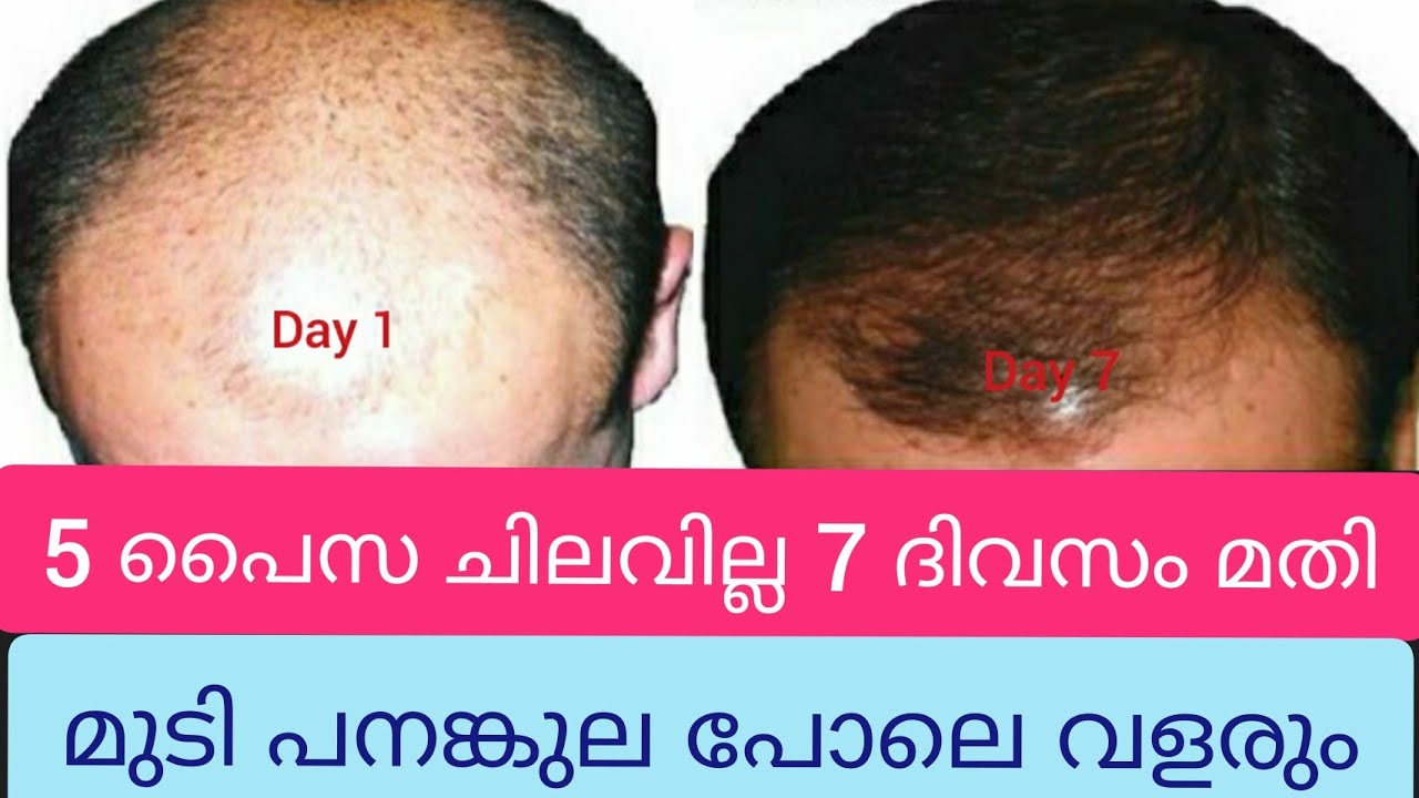 7 ദിവസം കൊണ്ട് കഷണ്ടി തലയിൽ മുടി വളരും Fenugreek water for hair growth