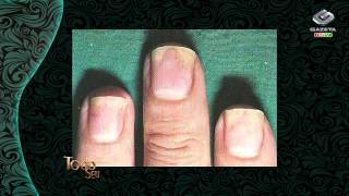 Todo Seu - Qual Ã© sua DÃºvida: Marcas e problemas nas unhas (06/11/13)