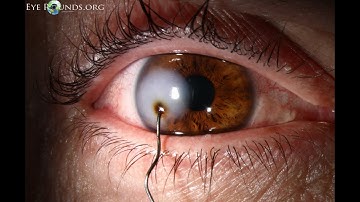 CPT codes for Removal of foreign body - simplify medical coding