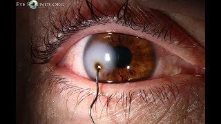 CPT codes for Removal of foreign body - simplify medical coding