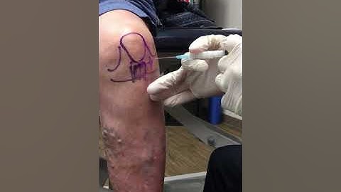 Anterior Knee Injection - Elite Sports Medicine - Lethbridge
