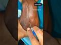 10 Second Me Clean Cannula Insertion 😳💉 #shorts #nursing #medicalstudent #trending #youtubeshorts