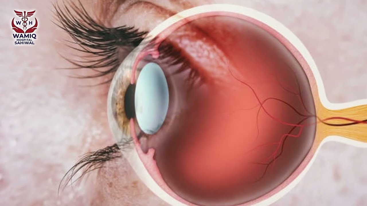 Prof. Dr. Ahmad Zeeshan Jameel | Expert Eye Specialist in Sahiwal | WAMIQ Hospital