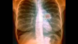 Reverse The Damage - Lung Cancer