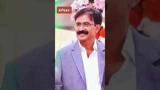 Hair Transplant Before and After: Transformation Stories. #shortvideo #videoviral