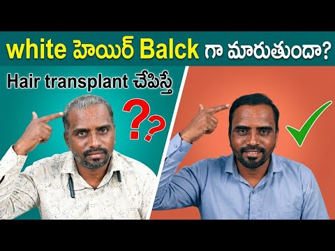 Hair transplant చేపిస్తే white హెయిర్ Balck గా మారుతుందా?