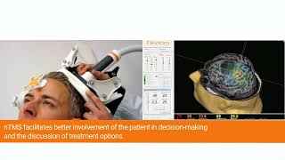 Nexstim Neurosurgery Pre-Operative Mapping