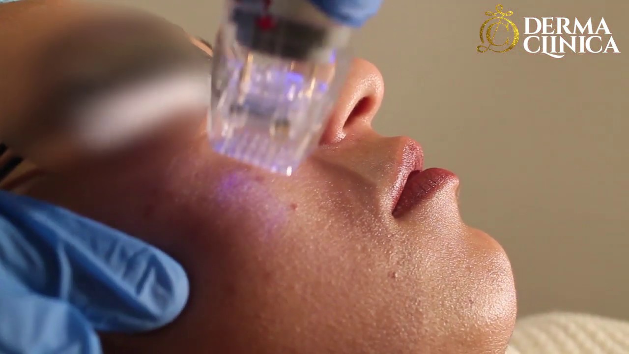 Scarlet Treatment by Dr. Hosam Khattab YouTube