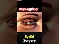 Eyelid Surgery Before & After 😳 #blepharoplasty