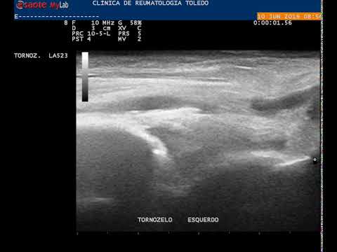 Vídeo: Osteoartrite Do Tornozelo