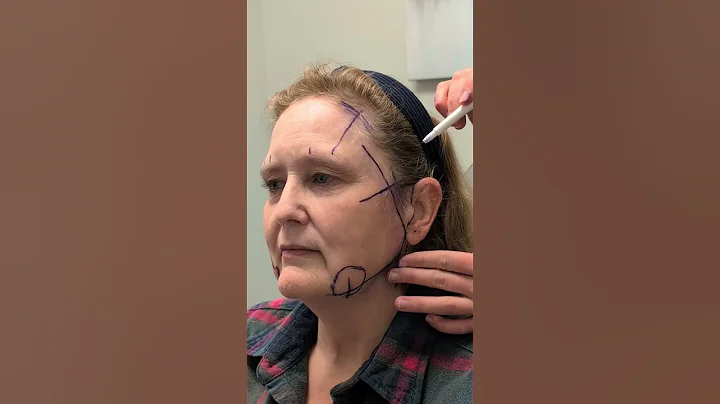 deep plane facelift, neck lift, and a customized brow lift