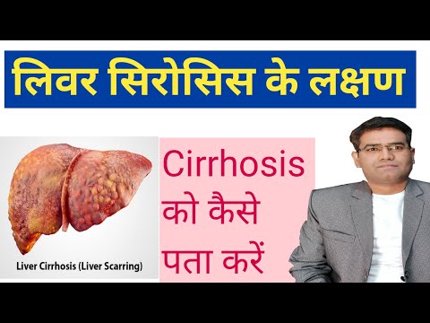 What are the Symptoms of Liver Cirrhosis? | लिवर सिरोसिस को कैसे पहचानें (इन हिंदी)