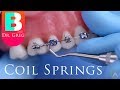 [BRACES EXPLAINED] Coil Springs