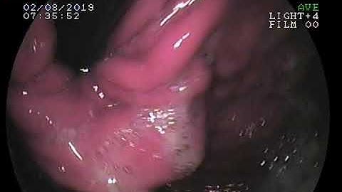 11072019 Laparoscopic Nissen Fundoplication Preop and postop endoscopic Assessment