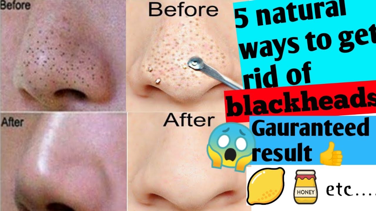 5 home remedies to get rid of blackheads naturally/best home remedies