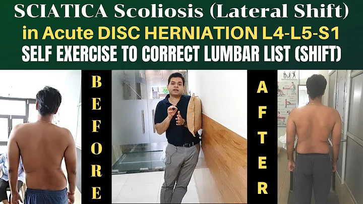 Sciatica Scoliosis, Lumbar Disc Herniation L4-L5-S1, Lateral Shift (LIST) Self Correction Exercise - DayDayNews