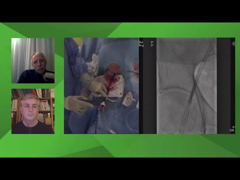 Patient with symptomatic AS using the THV Portico device with the FlexNav delivery system - Webinar