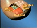 The News on Nails:  Lamisal Tablets