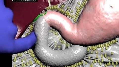 Kocher Maneuver (in 2 minutes) Animation by Cal Shipley, M.D.