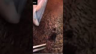 Ingrown hair for  your wait…