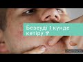 Безеуді қалай кетіреміз? 01.04.2021жыл