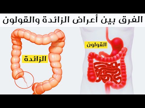 الفرق بين أعراض الزائدة والقولون