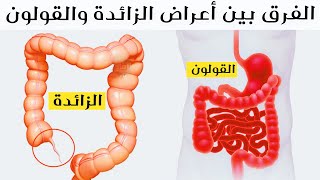 الفرق بين أعراض الزائدة والقولون