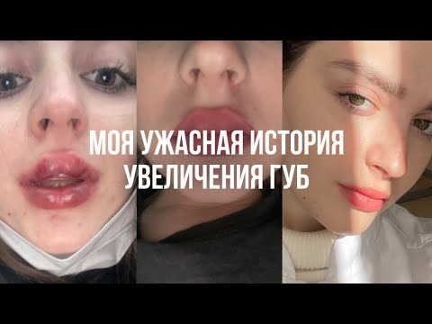 УВЕЛИЧЕНИЕ ГУБ | мой печальный опыт | как мне испортили губы